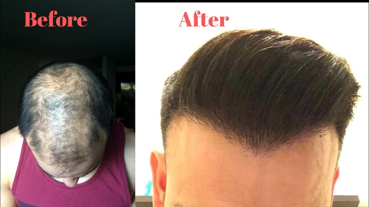 Hair Growth & Restoration